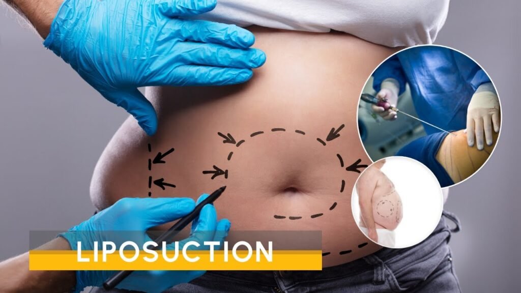 Liposuction