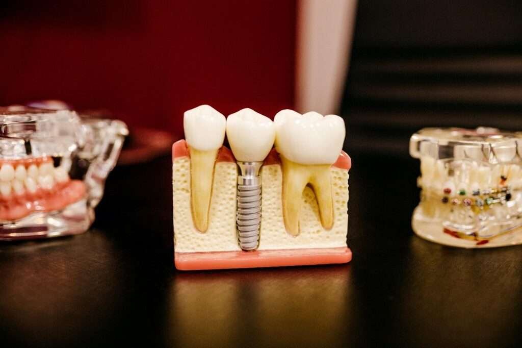 Explore Why You Should Consider Getting Dental Implants