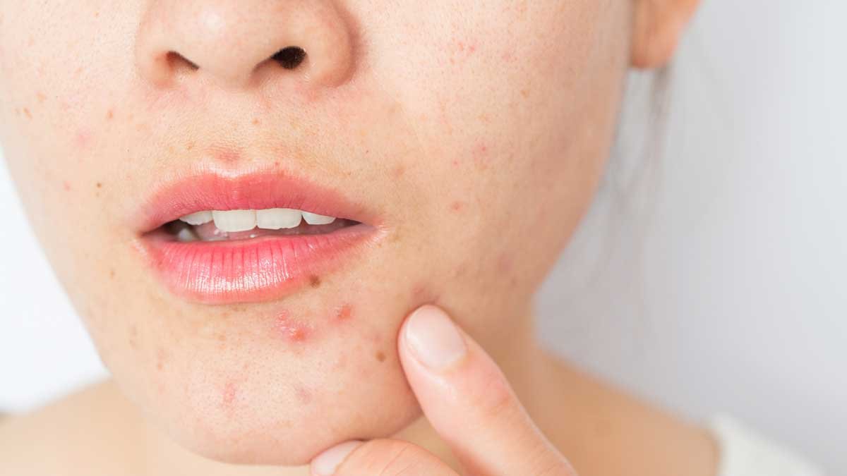 How Do Pimples Form Causes And Treatment